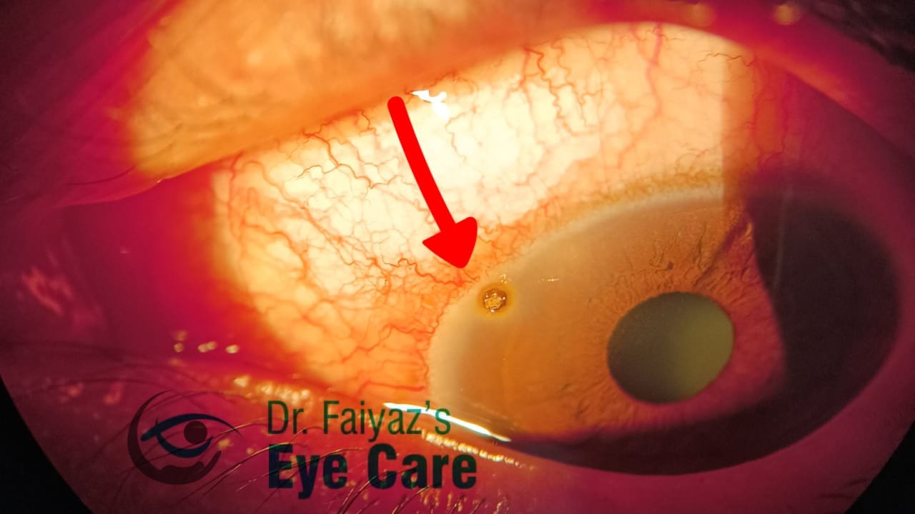 foreign body in eye